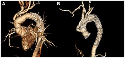 Comparison of Prognosis Between Hybrid Debranching Surgery and Total Open Arch Replacement With Frozen Elephant Trunk for Type A Acute Aortic Syndrome Patients